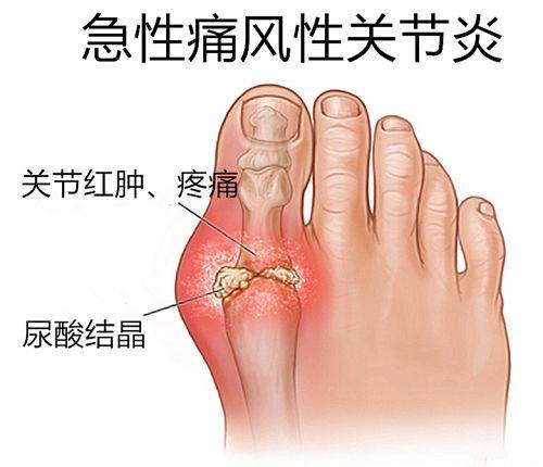 呼吸衰竭急性加重最常见的诱因_诱因_凌仕男士香氛诱因